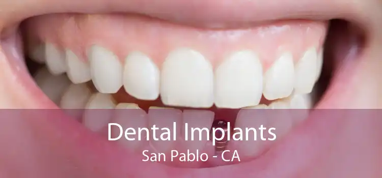 Dental Implants San Pablo - CA