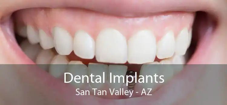 Dental Implants San Tan Valley - AZ