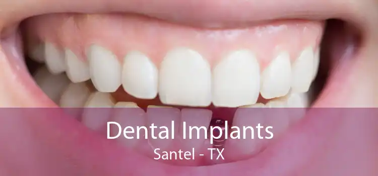 Dental Implants Santel - TX
