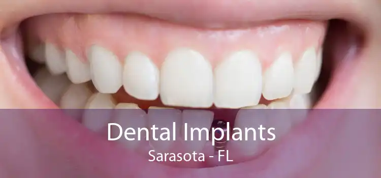 Dental Implants Sarasota - FL