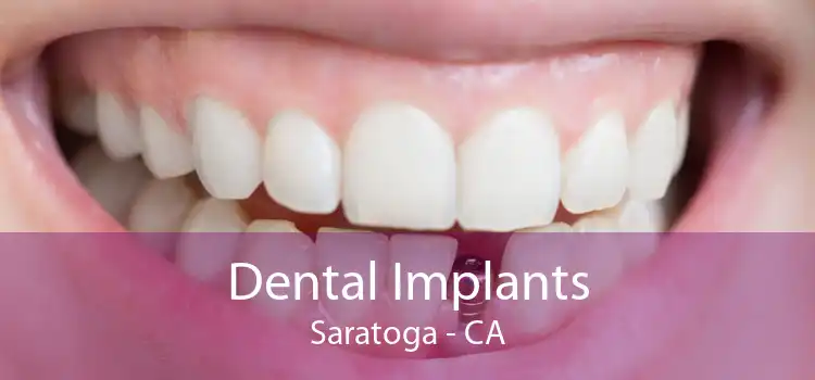 Dental Implants Saratoga - CA