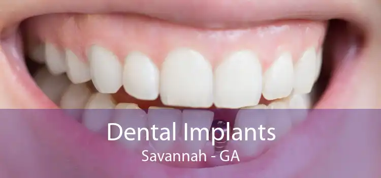 Dental Implants Savannah - GA
