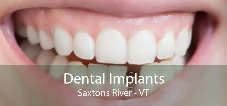 Dental Implants Saxtons River - VT