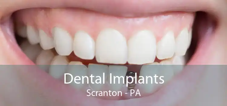 Dental Implants Scranton - PA