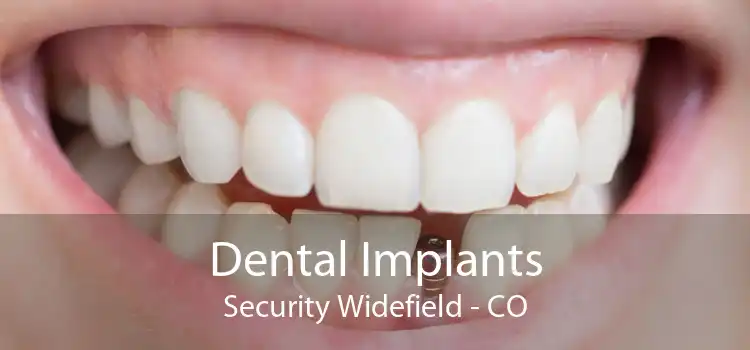 Dental Implants Security Widefield - CO