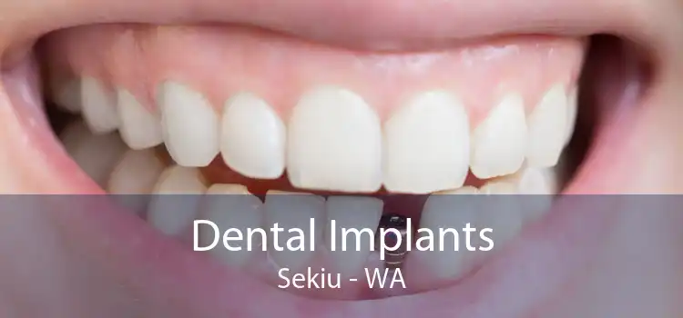 Dental Implants Sekiu - WA