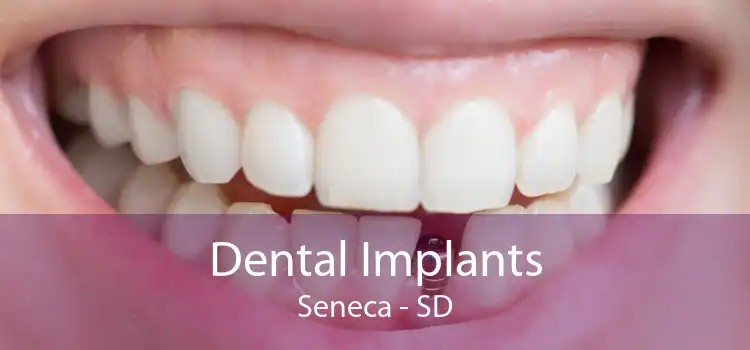 Dental Implants Seneca - SD