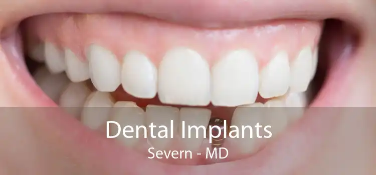 Dental Implants Severn - MD