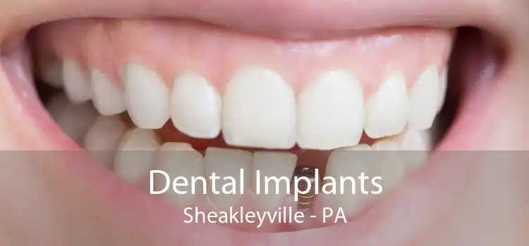 Dental Implants Sheakleyville - PA