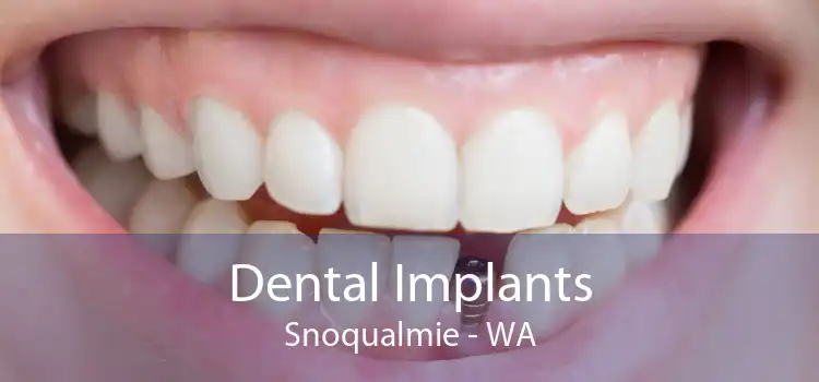 Dental Implants Snoqualmie - WA