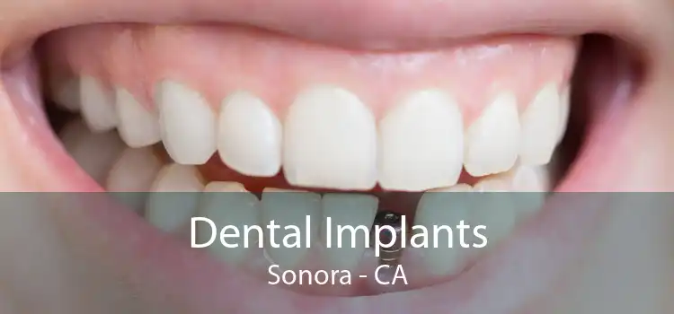 Dental Implants Sonora - CA