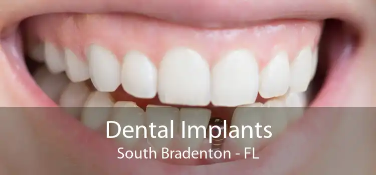 Dental Implants South Bradenton - FL
