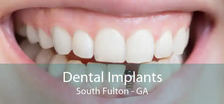 Dental Implants South Fulton - GA