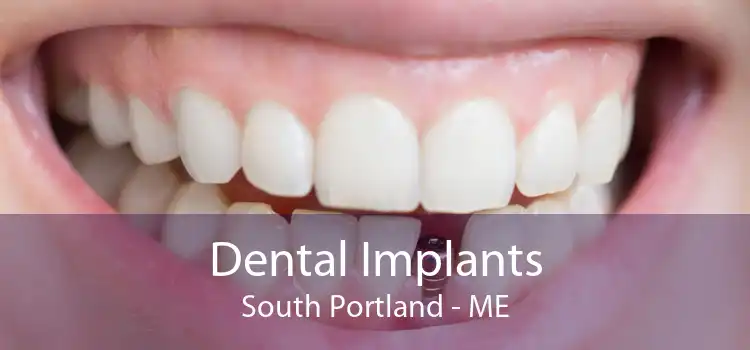 Dental Implants South Portland - ME