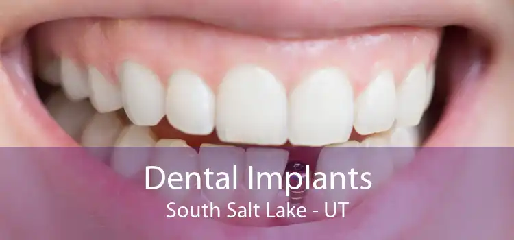 Dental Implants South Salt Lake - UT