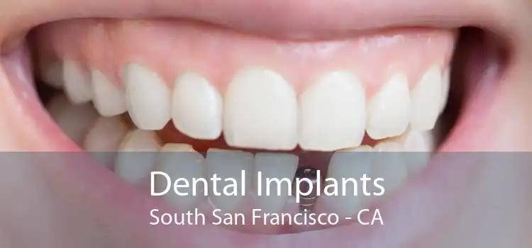 Dental Implants South San Francisco - CA