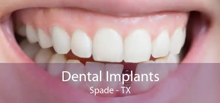Dental Implants Spade - TX