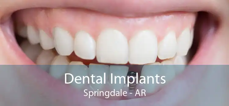 Dental Implants Springdale - AR