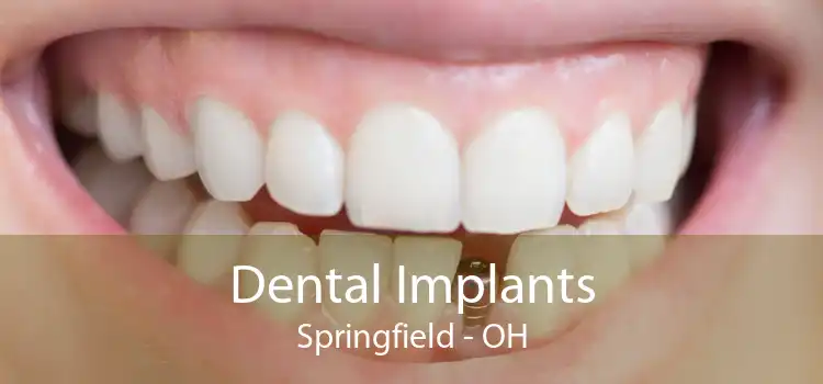 Dental Implants Springfield - OH