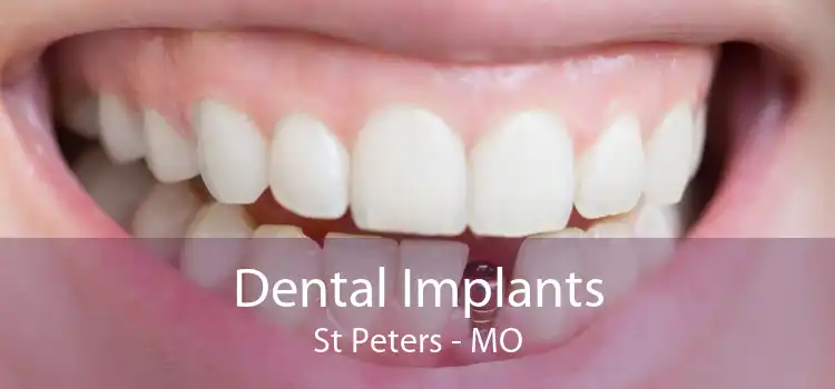 Dental Implants St Peters - MO