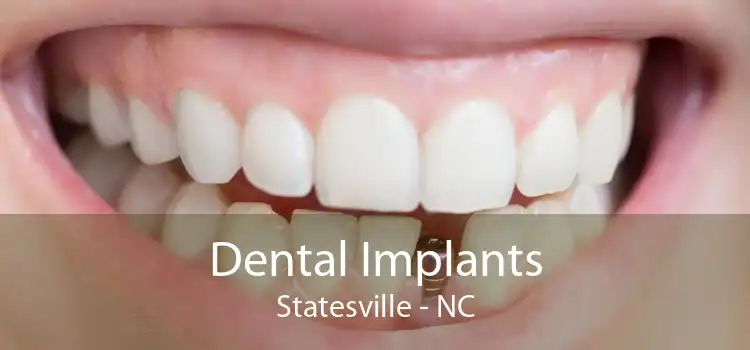 Dental Implants Statesville - NC