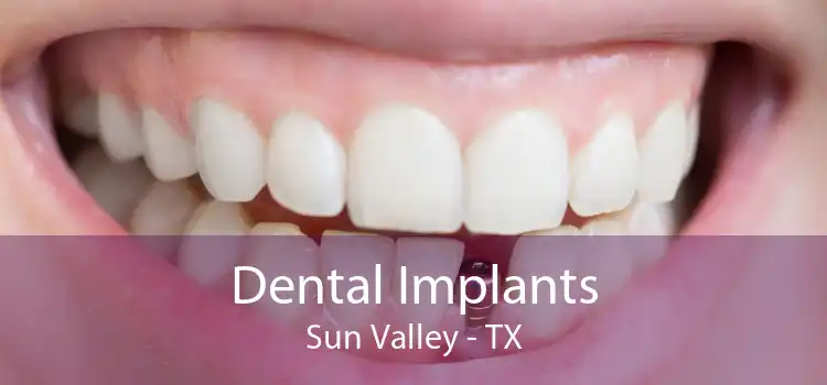 Dental Implants Sun Valley - TX