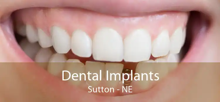 Dental Implants Sutton - NE