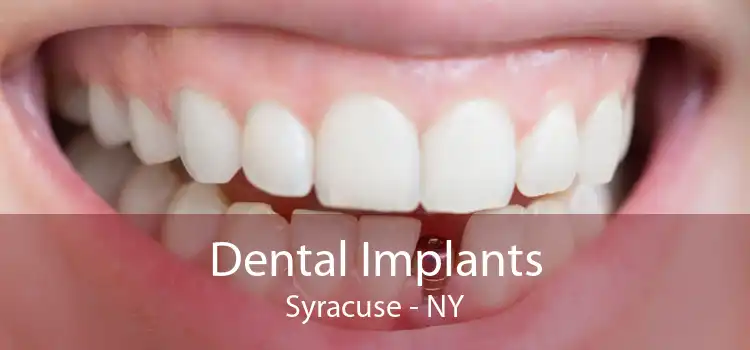 Dental Implants Syracuse - NY