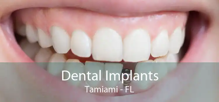 Dental Implants Tamiami - FL
