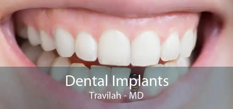 Dental Implants Travilah - MD