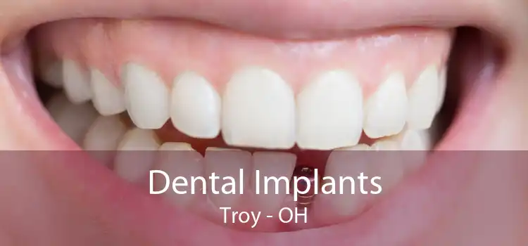 Dental Implants Troy - OH