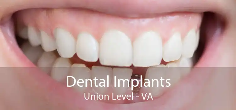 Dental Implants Union Level - VA