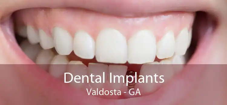 Dental Implants Valdosta - GA