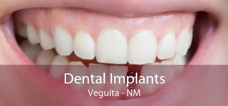 Dental Implants Veguita - NM