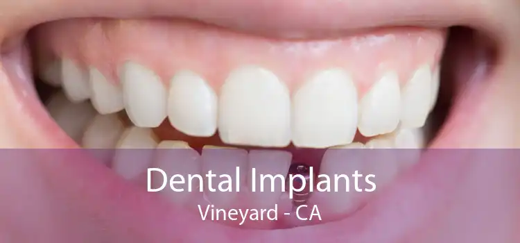 Dental Implants Vineyard - CA