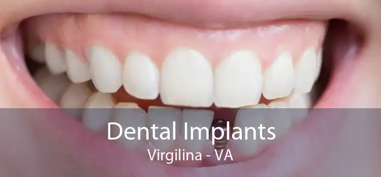 Dental Implants Virgilina - VA