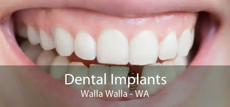 Dental Implants Walla Walla - WA