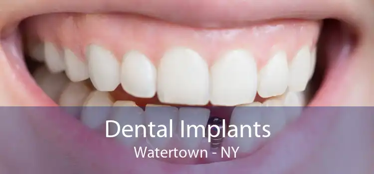 Dental Implants Watertown - NY