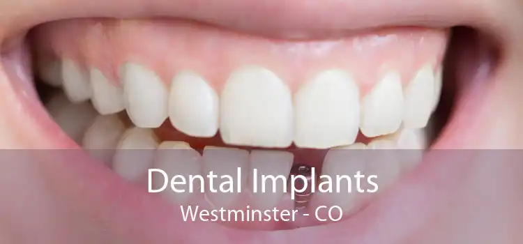 Dental Implants Westminster - CO