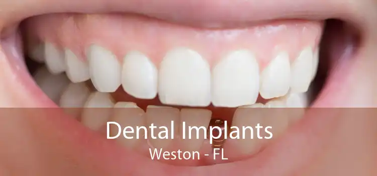 Dental Implants Weston - FL