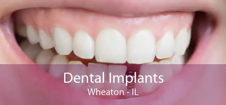 Dental Implants Wheaton - IL