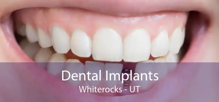 Dental Implants Whiterocks - UT