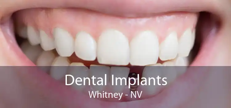 Dental Implants Whitney - NV