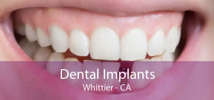 Dental Implants Whittier - CA