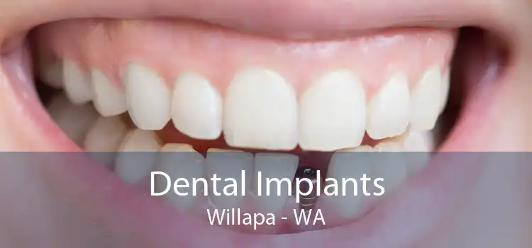 Dental Implants Willapa - WA