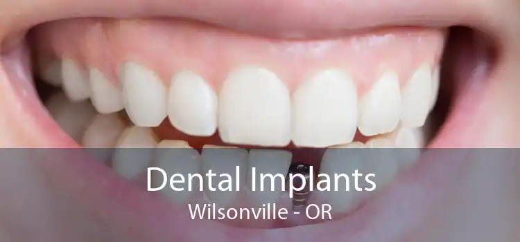 Dental Implants Wilsonville - OR