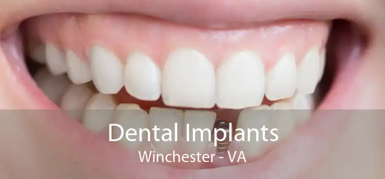 Dental Implants Winchester - VA