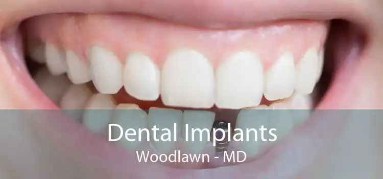 Dental Implants Woodlawn - MD