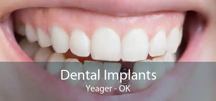 Dental Implants Yeager - OK