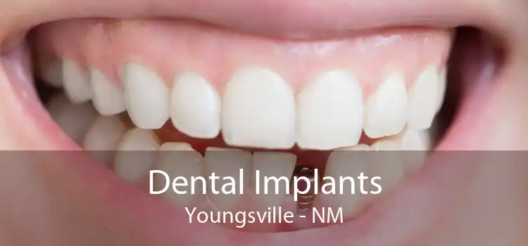 Dental Implants Youngsville - NM